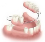 Perfect Smile chrome cobalt partial-denture